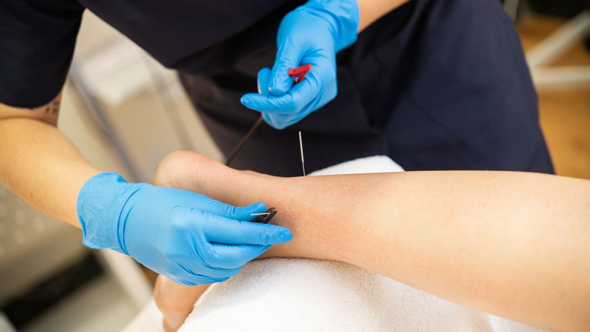 Clinician performing dry needling therapy on a patient's muscle trigger point
